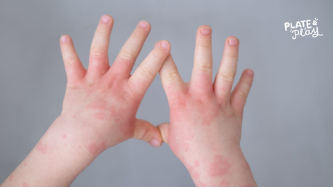 Food Allergy vs Food Intolerance